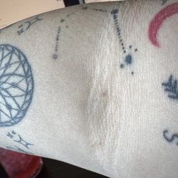 Labcorp - My arm the next day!
