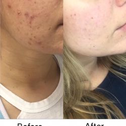 After 5 IPL Photofacial treatments