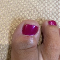 Cut on cuticle and minor infection the day after I had toes done at Envy Nails