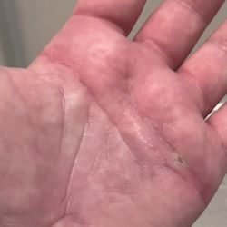 Modern Alchemist Compounding Pharmacy - Just 5 weeks after while using Modern Alchemist compounded organic, preservative free scar cream