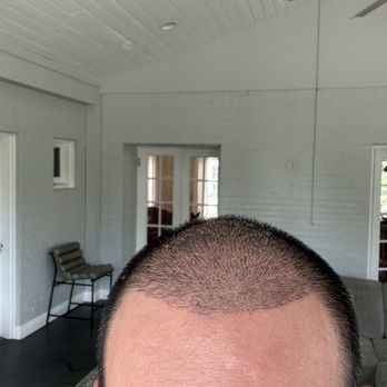 TJ Hair System - Day 15 - Hair Loss Centers Near Me - Tijuana, BCN TJ Hair System - Day 15 - Hair Loss Centers Near Me - Tijuana, BCN