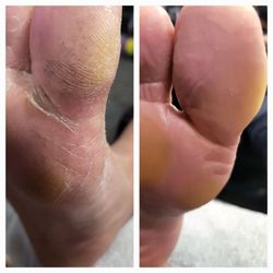 The Nail Industry Therapeutic Footcare - Callus reduction pedicure