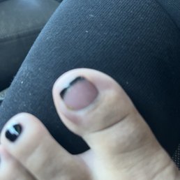 Infected toe afterwards