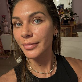 Nova Skin Space - Evening after full face PRP - Medical Spas Near Me - Costa Mesa, California