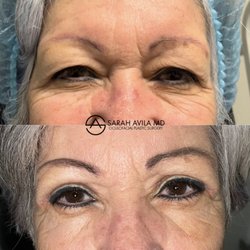 Sarah Avila, MD - Ptosis repair with Blepharoplasty