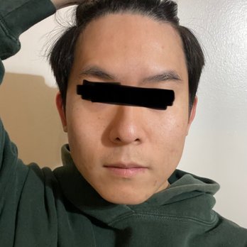 Delight Skin Clinic - One week after the treatment - Skin Care Near Me - Torrance, California Delight Skin Clinic - One week after the treatment - Skin Care Near Me - Torrance, California