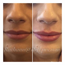 John G Apostolides, MD - 1 syringe of Juvederm