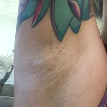 Nu Me Laser - You cannot laser where tattoos are. Thankfully this portion of my underarm doesn't flare up as bad as the rest. I haven't shaved in 5 days! - Weight Loss Centers Near Me - Virginia Beach, Virginia
