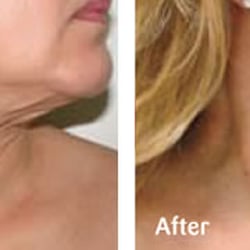 Above and Beyond - Tone and lift sagging skin