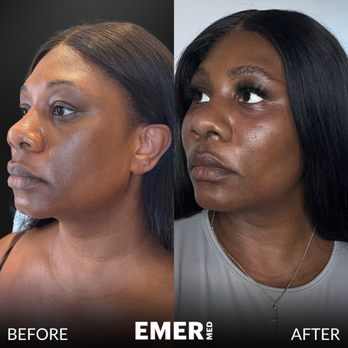Jason Emer, MD - After seeing one of my recent viral TikToks, my patient wanted our facial sculpting treatment! We refreshed and defined her facial feautres - Dermatologists Near Me - New York, New York Jason Emer, MD - After seeing one of my recent viral TikToks, my patient wanted our facial sculpting treatment! We refreshed and defined her facial feautres - Dermatologists Near Me - New York, New York