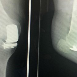 Edward M Adler, MD - Edward Adler, MD: Hip Replacement Surgeon, Knee Replacement Surgeon