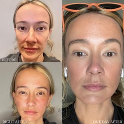 Re-Nu Aesthetics - BEFORE & AFTER Sculptra for a more symmetric face as well as an even skin tone and a reduction in pore size.