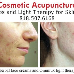 Aram Akopyan, MATCM LAc Dipl OM - Our clinic offers cosmetic acupuncture and natural Acne treatments