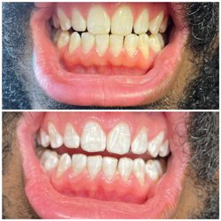 Teeth whitening service