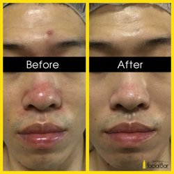 The Original Facial Bar - Before and after Acne Facial!  Book now: https://go.booker.com/location/TheOriginalFacialBar/service-menu