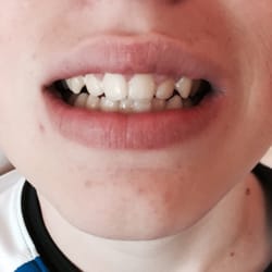 WenWu, DDS - AFTER... You can't tell it was ever chipped. Smile restored!