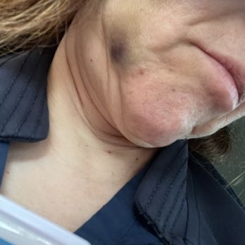 212 Dental Care - Post treatment bruise. - General Dentistry Near Me - New York, New York 212 Dental Care - Post treatment bruise. - General Dentistry Near Me - New York, New York
