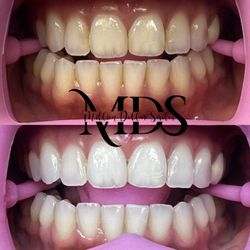 Million Dollar Smiles - We offer 40 minute and 60 minute whitening sessions. LED Teeth Whitening is the quickest and most effective way to get your smile glowing!