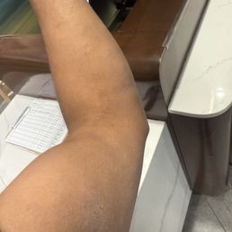 Rash from sleeping in bed