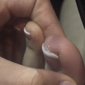 Elegant Nails - Skin damage - Massage Near Me - Christiansburg, Virginia Elegant Nails - Skin damage - Massage Near Me - Christiansburg, Virginia