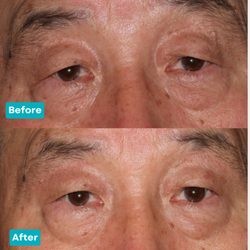 Dr. Burnstine performed a sub-brow blepharoplasty, preserving this patient's natural monolid and enhancing his vision.