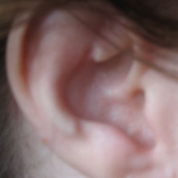 Andrew S.Frankel,MD - My right ear after Dr. Frankel removed cartilage from it to use in my nose. - Plastic Surgeons Near Me - Beverly Hills, California
