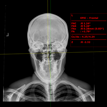 Atlanta Upper Cervical Chiropractic - Before: measurements showing an upper cervical misalignment. - Chiropractors Near Me - Decatur, Georgia