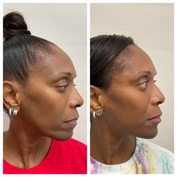 Balanced Beauty Med Spa - TWELVE SYRINGES OF FILLER. Full face balancing for natural results.