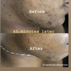 Lux Studio Houston - Deep clearing hyperpigmentation Facial