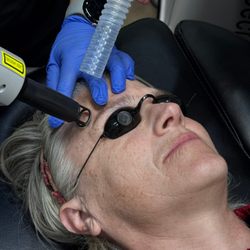 IAM Radiance - Erbium YAG Laser Treatment