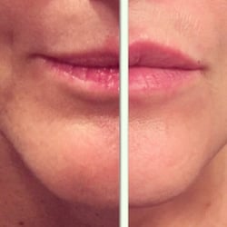 Beauty Religion - Side by side Before and after Juvederm lip injections. Natural and younger looking result