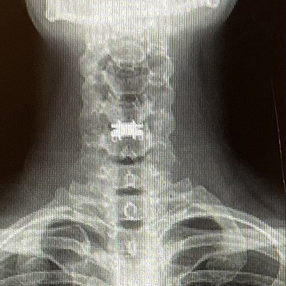 Sean Keem, MD - C5-C6 scoliosis, new after surgery - Orthopedists Near Me - Seattle, Washington