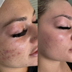 Bubble Bar Spa - BioRePeel Results