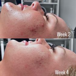 Serenity Skin Therapy - 8 week treatment series consisting of one weekly facial and a full home care routine to manage acne pustules and scaring.