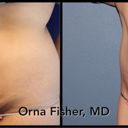 Elite Transformations, Orna Fisher, MD - Abdominoplasty (tummy tuck) by Dr. Orna Fisher, board-certified plastic surgeon