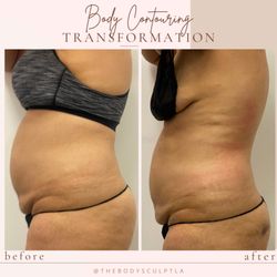 The Body Sculpt LA - 4 sessions in and 14 days apart.