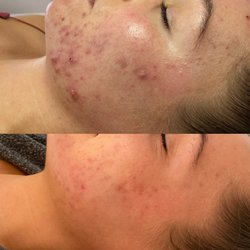 The Acne Concept - Before & After