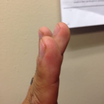 Physicians Immediate Care - This is their tendon repair - Urgent Care Near Me - Chicago, Illinois Physicians Immediate Care - This is their tendon repair - Urgent Care Near Me - Chicago, Illinois