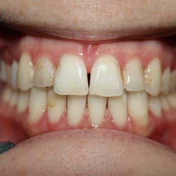 Revive Dental - Before - Cosmetic Dentists Near Me - Marriottsville, Maryland Revive Dental - Before - Cosmetic Dentists Near Me - Marriottsville, Maryland