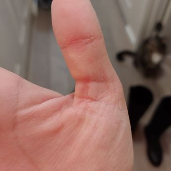 Aloha Nail - My hands are peeling from sitting in rubbing alcohol for over 30 minutes. - Nail Salons Near Me - Las Vegas, Nevada Aloha Nail - My hands are peeling from sitting in rubbing alcohol for over 30 minutes. - Nail Salons Near Me - Las Vegas, Nevada