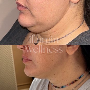 Illumin Wellness - Cryotherapy Near Me - Danville, California