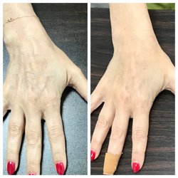 Ivan Brooks, MD - Beverly Hills Vein Institute - Hand sclerotherapy works really well! Beautiful results