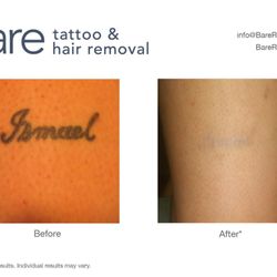 Bare Tattoo & Hair Removal - Bare Tattoo & Hair Removal in Chicago & Munster