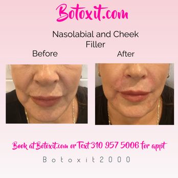 Botox It - Nasolabilal and Cheek Filler - Cosmetic Surgeons Near Me - Tustin, California Botox It - Nasolabilal and Cheek Filler - Cosmetic Surgeons Near Me - Tustin, California