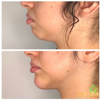 Santosha Aesthetics - Chin filler. - Medical Spas Near Me - Beverly Hills, California Santosha Aesthetics - Chin filler. - Medical Spas Near Me - Beverly Hills, California