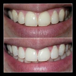 The Jaw Dropper - Before & After
