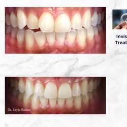 Comfort Keepers of Park Ridge - Invisalign treatment