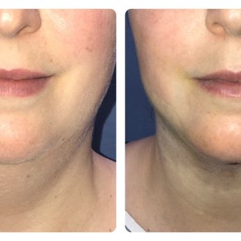 Thomas W. Barnes, MD - Second picture immediately after the procedure, while I was still on the table. - Cosmetic Surgeons Near Me - Newport Beach, California