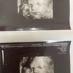 Jack and Jill Fetal Photos - UltrasoundPictures.
