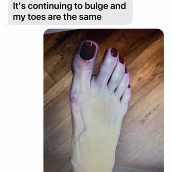 Jeffrey R. Benzing, D.P.M. - My before surgery foot. Becky, I met whose foot He messed up. She sent me a photo of a woman she met who lost her left toes by him. - Podiatrists Near Me - Bay Saint Louis, Mississippi